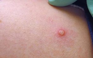 Mpox: como é a transmissão da doença declarada emergência mundial