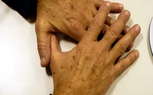 Hospital das Clínicas de SP faz avaliação gratuita de prevenção ao câncer de pele